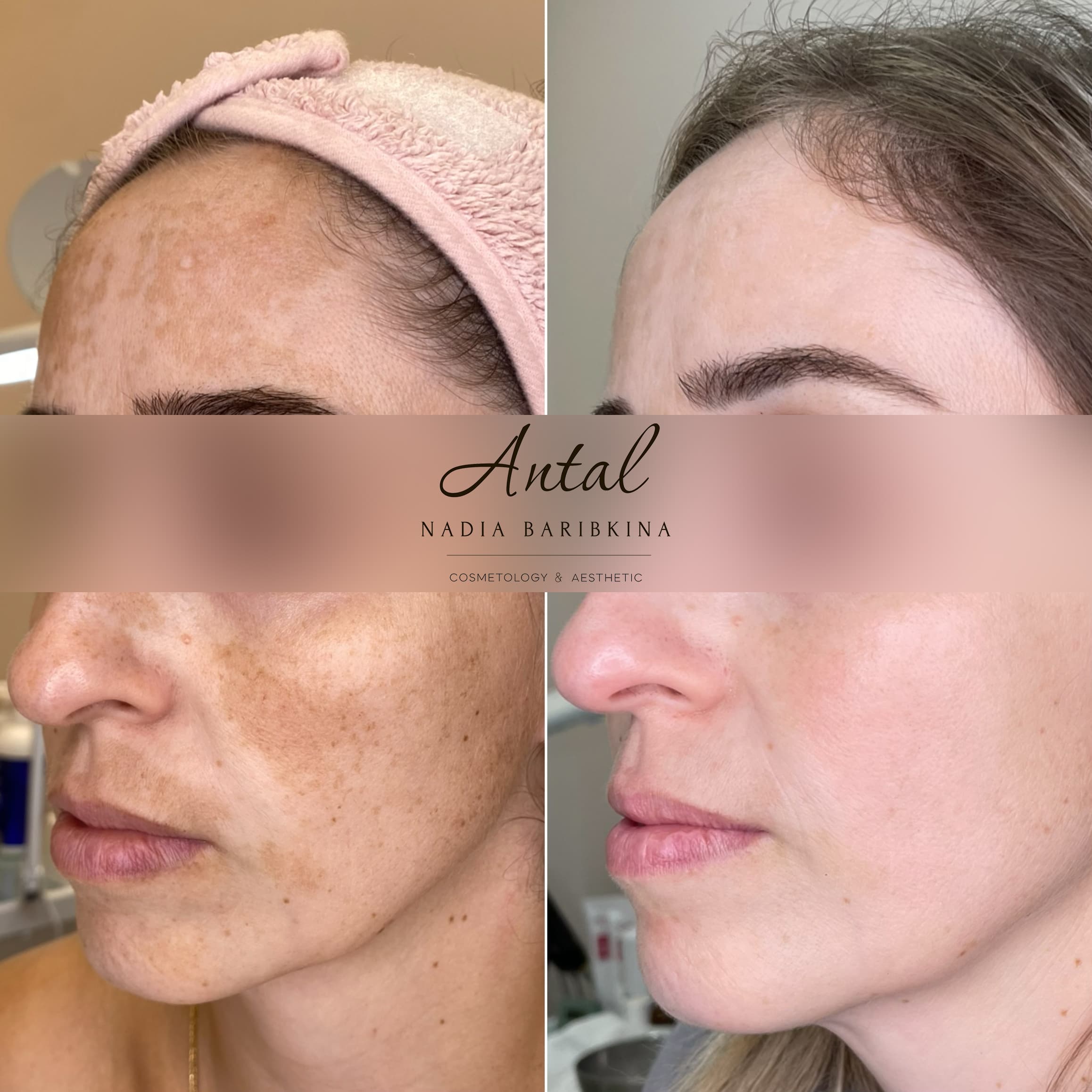 תוצאה לפני ואחרי 1